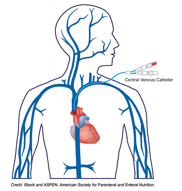 Central_Venous_Catheter_Half-body Central_Venous_Catheter_Half-body